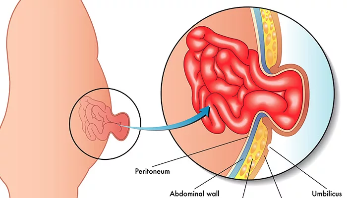 Best Hernia Surgeon in Woodlands Hospital, Kolkata