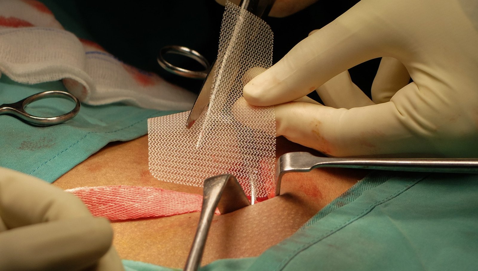 Advanced Hernia Treatment