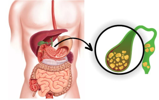 Best Gallbladder Stone Surgeon in Kolkata
