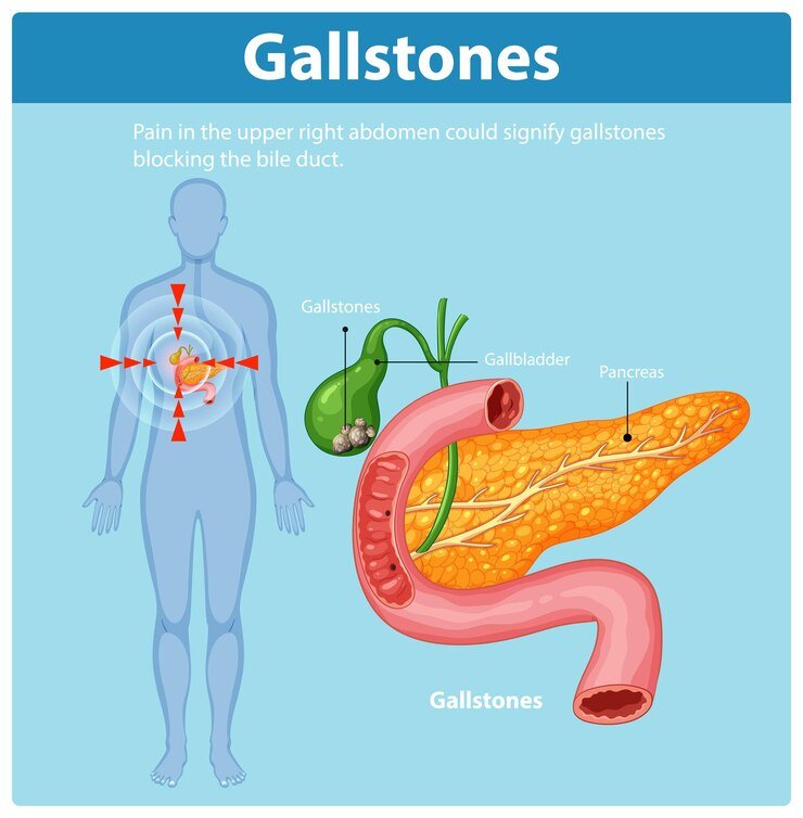 Best Gallbladder Stone Surgeon in Kolkata