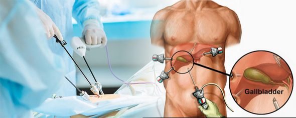 Laparoscopic gallbladder surgery