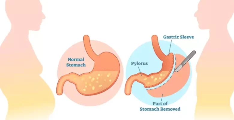 best bariatric surgeon in kolkata