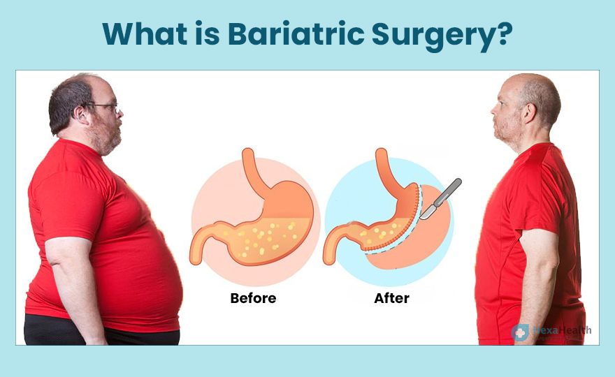 Bariatric Surgery in Kolkata