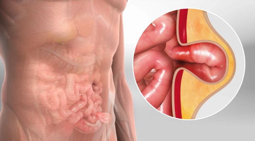 laparoscopic hernia surgeon in kolkata