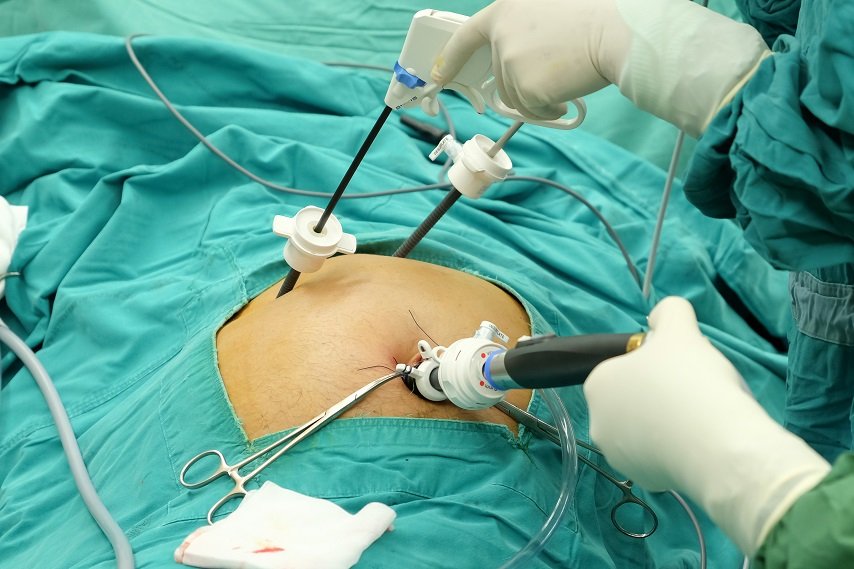 Laparoscopic Gallbladder Surgery