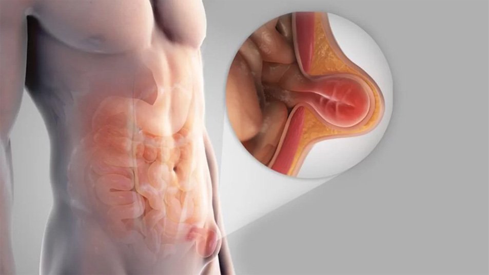 Symptoms of Hernia