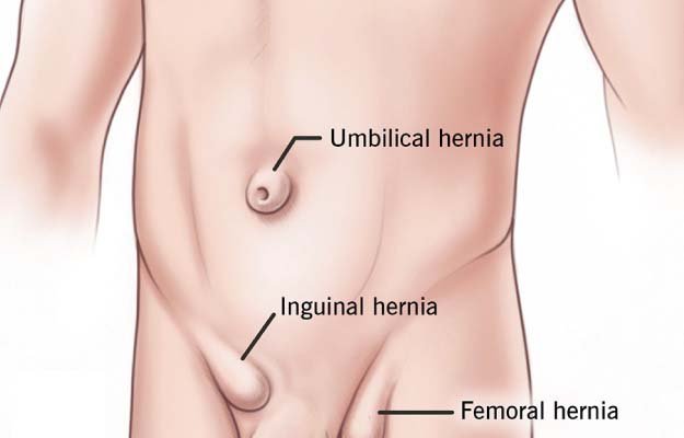 laparoscopic hernia surgery by Dr. Sumantra Ray