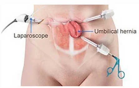 laparoscopic hernia surgeon in kolkata
