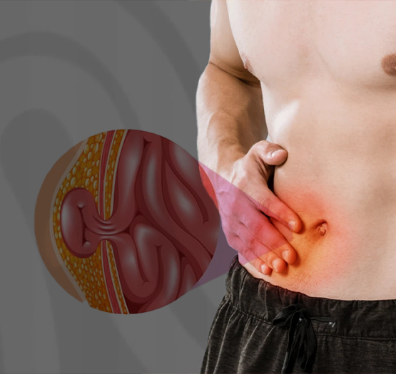 Laparoscopic hernia surgeon in kolkata