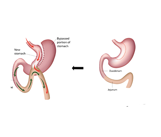 Bariatric Surgery in Kolkata