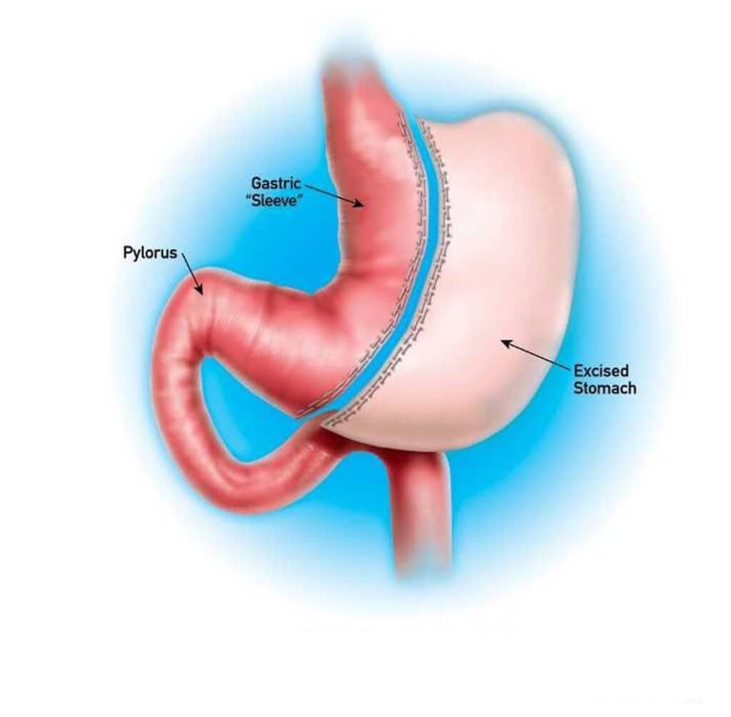 Bariatric surgery in kolkata